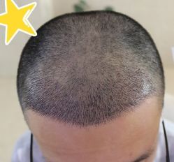 -大麦微针植发丨全国连锁