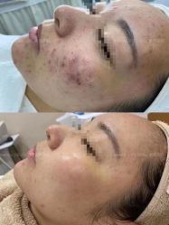 -苗方清颜痘肌研究所