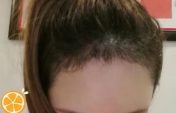 -大麦微针植发丨全国连锁