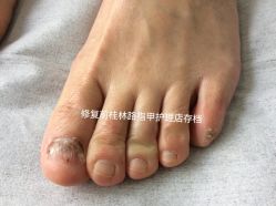 -德哥灰指甲脚气甲沟炎跖疣护理