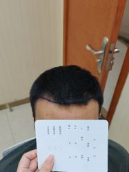 -碧莲盛·不剃发植发