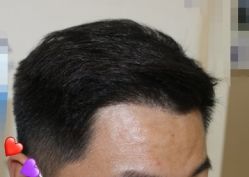 -大麦微针植发丨全国连锁