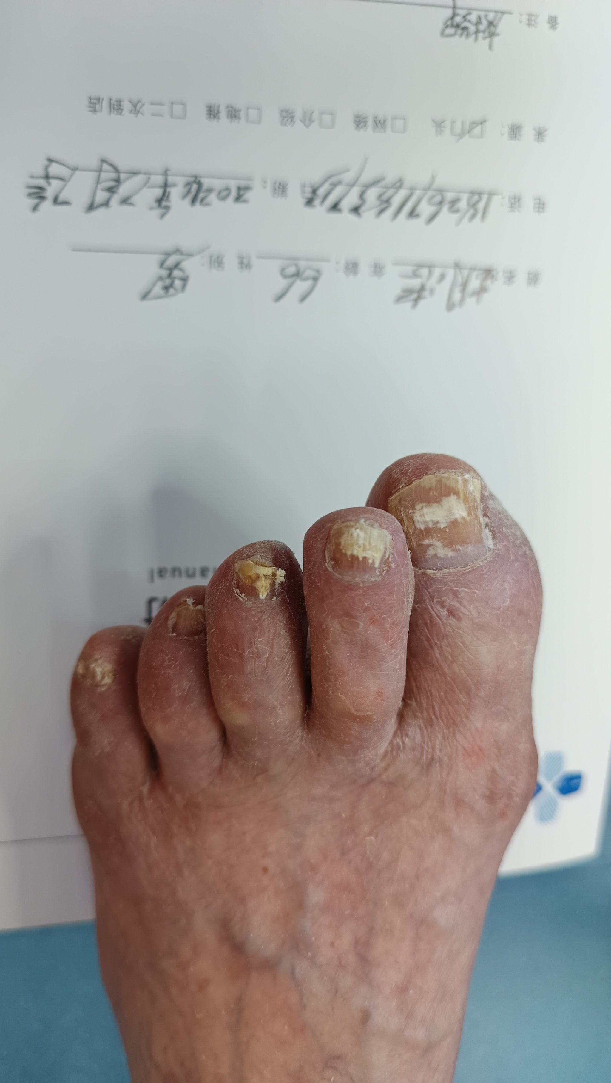 灰指甲苦不堪言