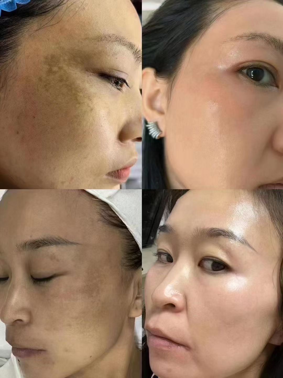 脸上为什么会长斑