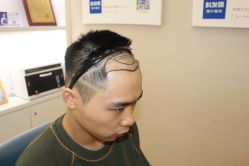 -大麦微针植发丨全国连锁