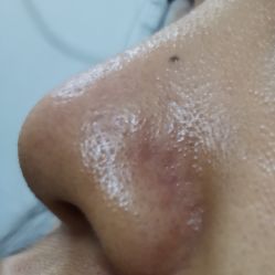 体验后-东莞缔美美容医院