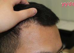 -大麦微针植发丨全国连锁