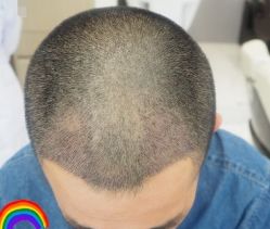 -大麦微针植发丨全国连锁