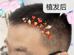 -大麦微针植发全国连锁