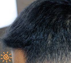 -大麦微针植发丨全国连锁