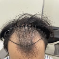 -碧莲盛·不剃发植发