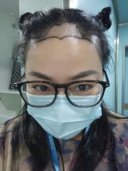 -大麦微针植发丨全国连锁