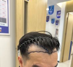 -大麦微针植发全国连锁