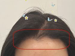 -大麦微针植发全国连锁