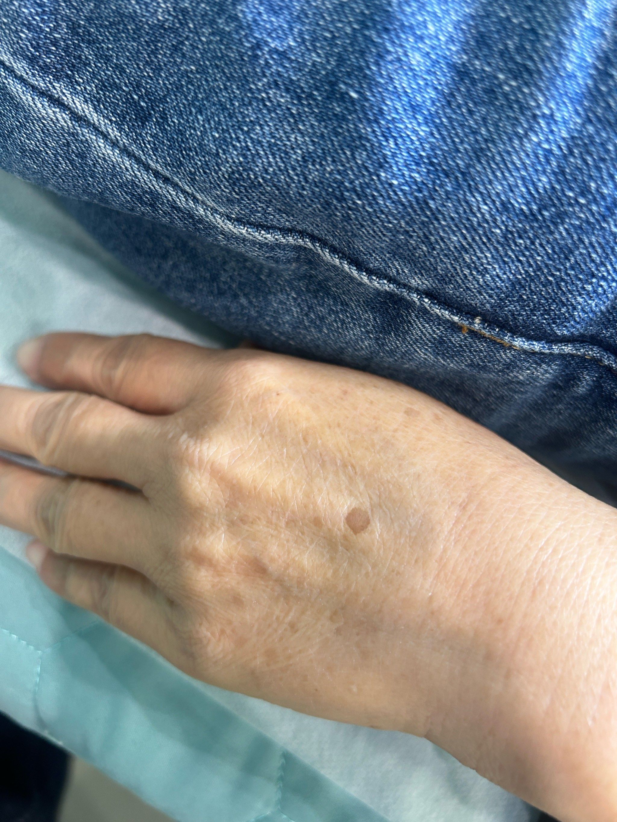 手上的老年斑就这么的不见了!