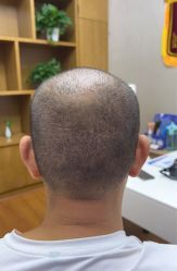 体验后-大麦微针植发全国连锁