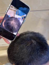 -碧莲盛·不剃发植发