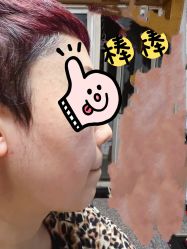 -美丽人生祛斑扁平疣汗管瘤中心