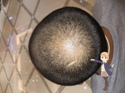 -大麦微针植发丨全国连锁