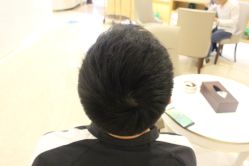 -大麦微针植发丨全国连锁