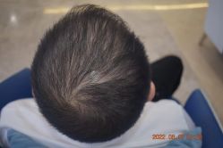 -大麦微针植发全国连锁