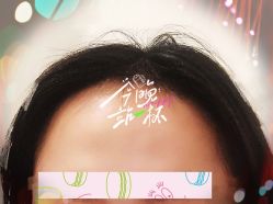 -大麦微针植发全国连锁