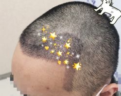 -大麦微针植发全国连锁