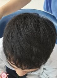 -大麦微针植发丨全国连锁