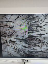 -大麦微针植发全国连锁