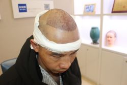 -大麦微针植发丨全国连锁