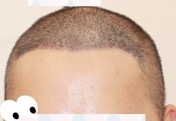 -大麦微针植发全国连锁