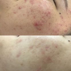 -蕾特恩专业祛痘·皮肤管理