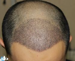 -大麦微针植发丨全国连锁