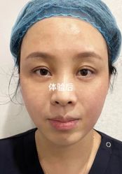 点击看大图 体验后-脸博士医疗美容·眼鼻整形·抗衰中心