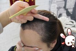 -大麦微针植发丨全国连锁