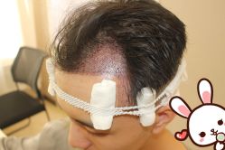 -大麦微针植发丨全国连锁