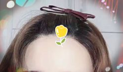 -大麦微针植发全国连锁