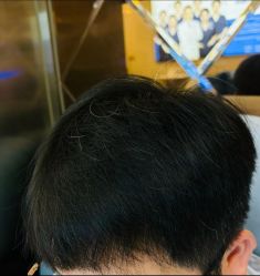 -碧莲盛·不剃发植发