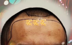 -大麦微针植发全国连锁