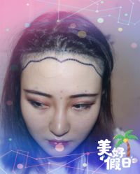 -大麦微针植发全国连锁