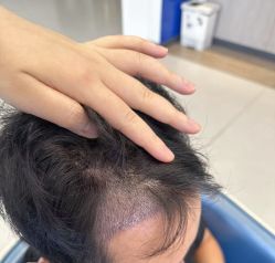 -大麦微针植发全国连锁