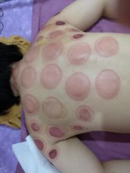 -苗塑堂减肥艾灸