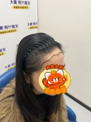 -大麦微针植发全国连锁