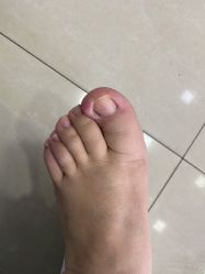 -德哥灰指甲脚气甲沟炎跖疣护理
