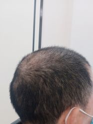 点击看大图 -大麦微针植发丨全国连锁