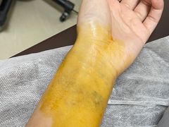 -杭州仁易堂中医康复医院疤痕修复