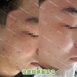 体验后-塑青春&伊肤泉祛痘皮肤管理