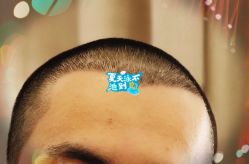 -大麦微针植发全国连锁