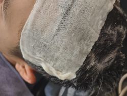 -碧莲盛·不剃发植发