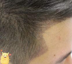 -大麦微针植发丨全国连锁